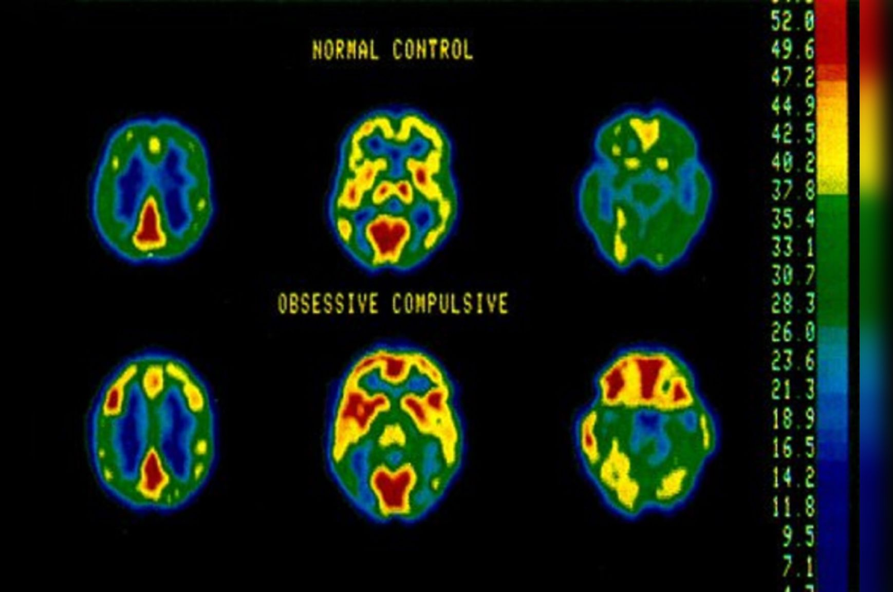 What does an OCD brain look like, PET scan. Source: Yale School of Medicine