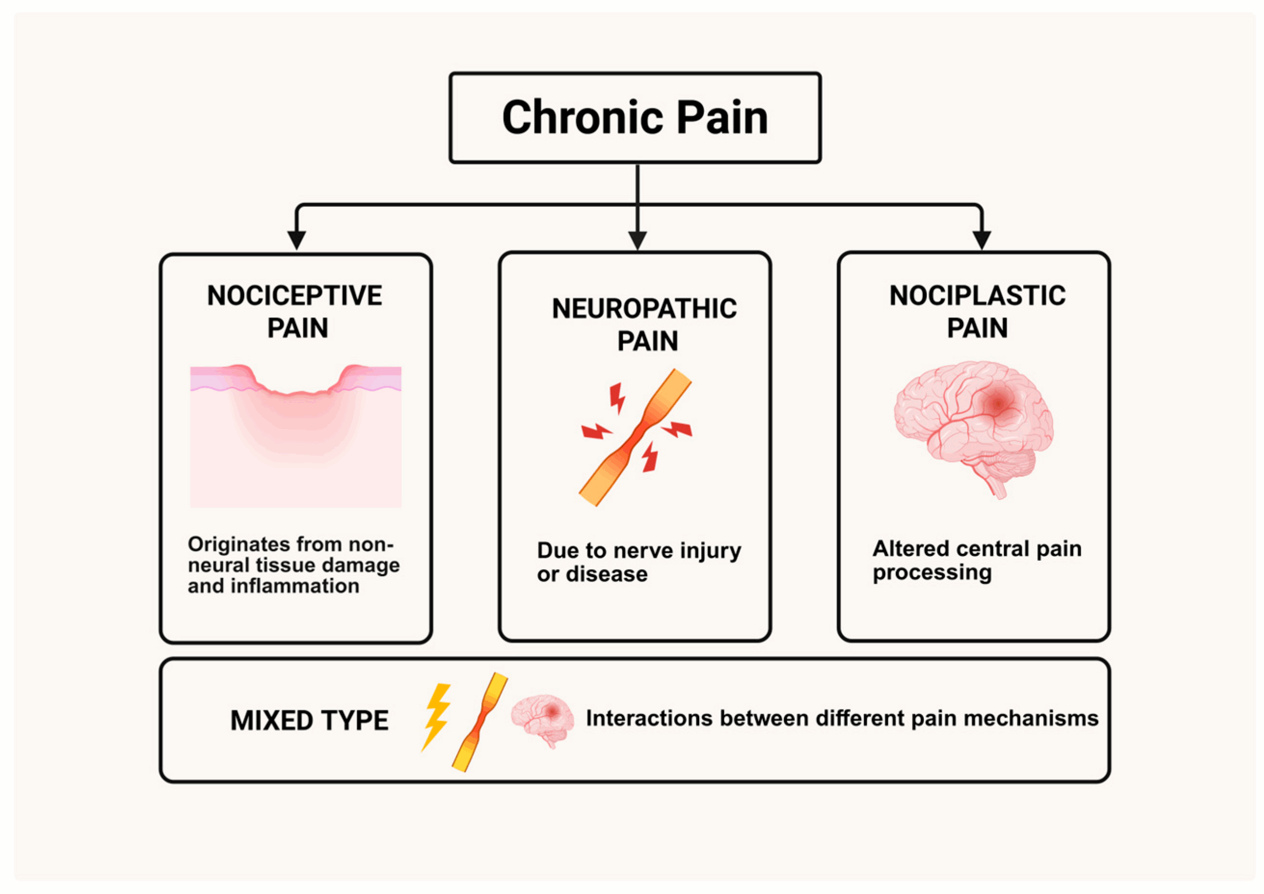 Infographic showing three types of chronic pain: nociceptive pain from tissue damage and inflammation, neuropathic pain from nerve injury or disease, and nociplastic pain from altered central processing, plus mixed type combining mechanisms.