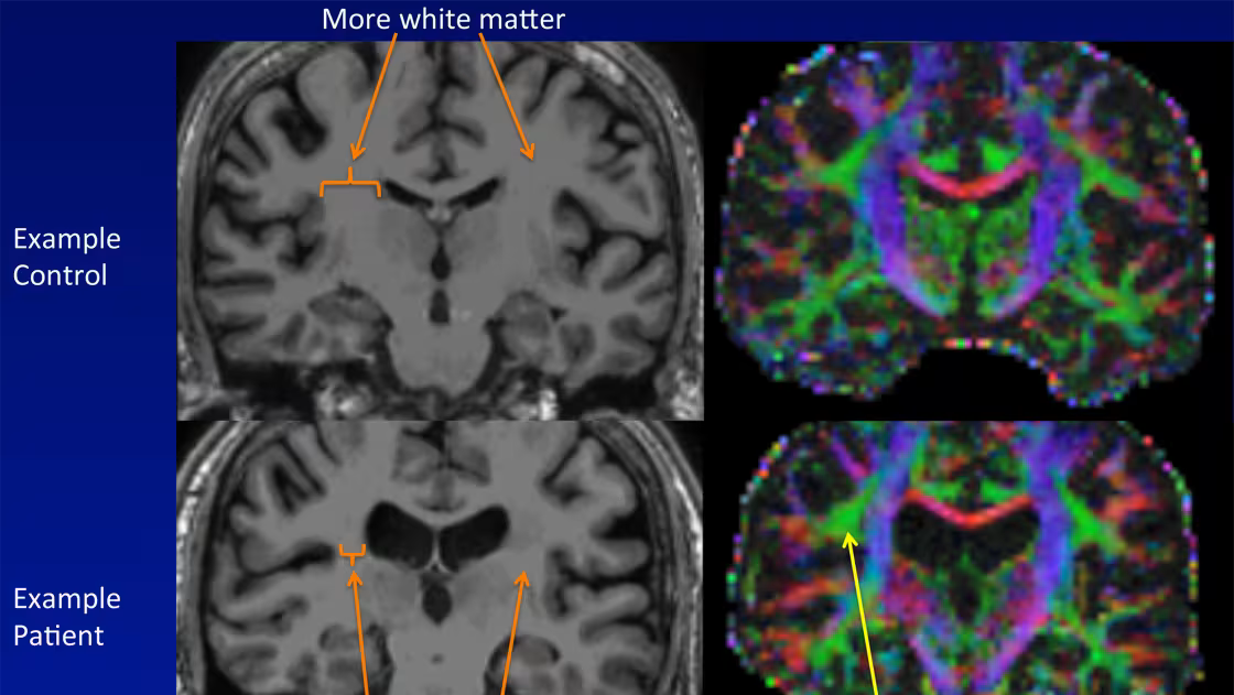 MRI brain scans comparing a healthy control and a patient with chronic fatigue syndrome (ME/CFS). The control brain (top) shows more white matter, while the patient brain (bottom) displays reduced white matter volume and altered connectivity patterns, highlighted by arrows.