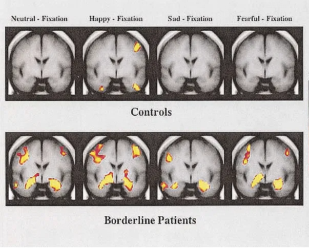 fMRI scans comparing emotional processing in healthy controls and patients with BPD. Source: National Education Alliance for BPD